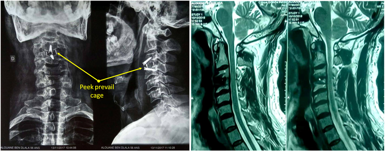 Hernie Discale Cervicale A Letage C C Avec Canal Cervical Retr Ci 52650