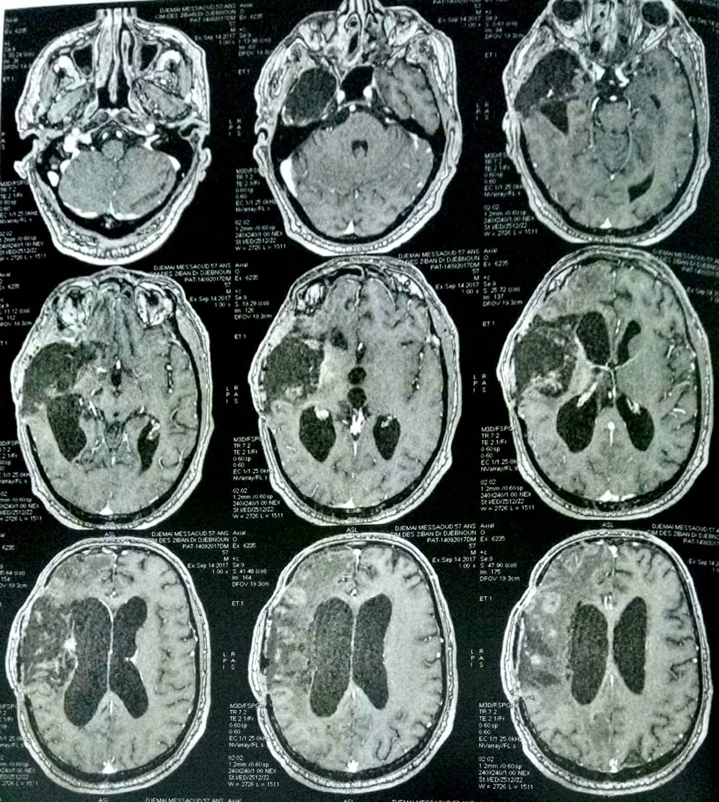 13 mois après : absence totale de récidive tumorale