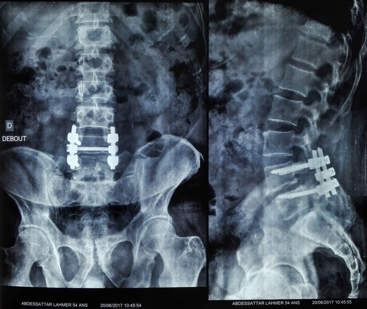  réduction du spondylolisthésis