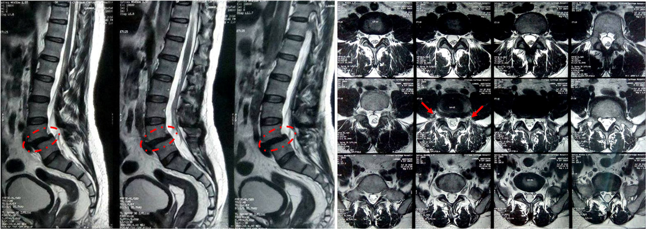 spondylolisthésis grade I de L4 sur L5