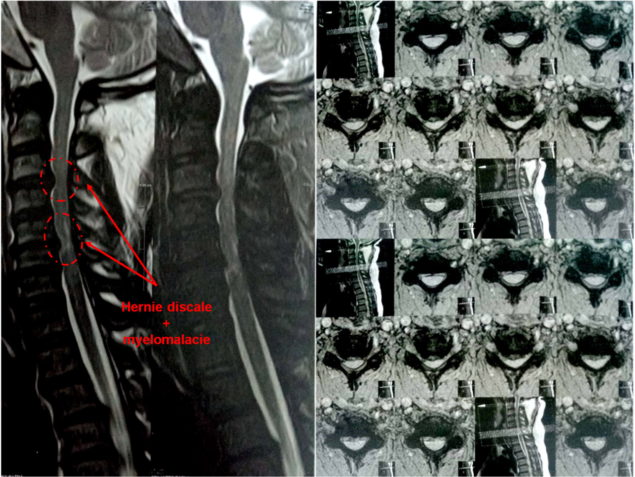 Hernies Discales Cervicales En C C Et C C Avec Souffrance Medullaire Myelomalacie En